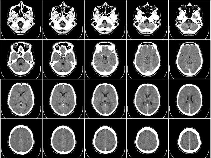 Tomografía computarizada (CT) de un cerebro humano